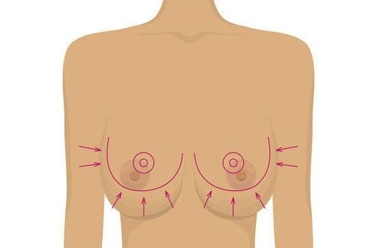 What size will I be after breast reduction? What size will I be after breast reduction?
